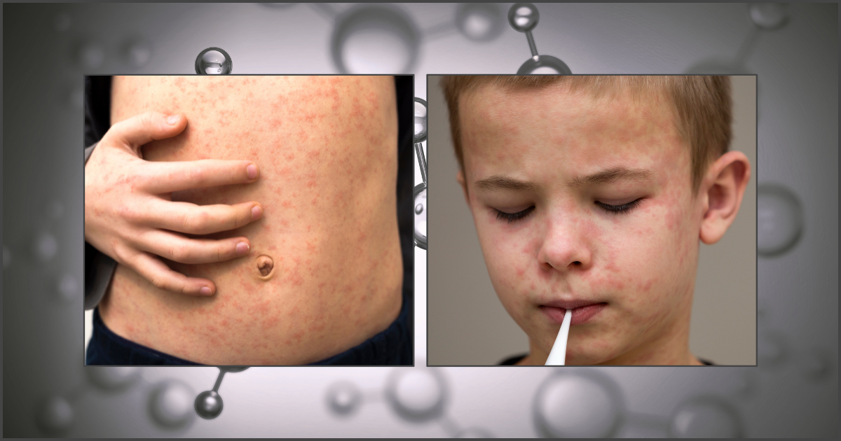 Know the signs. Skin rash from Measles 