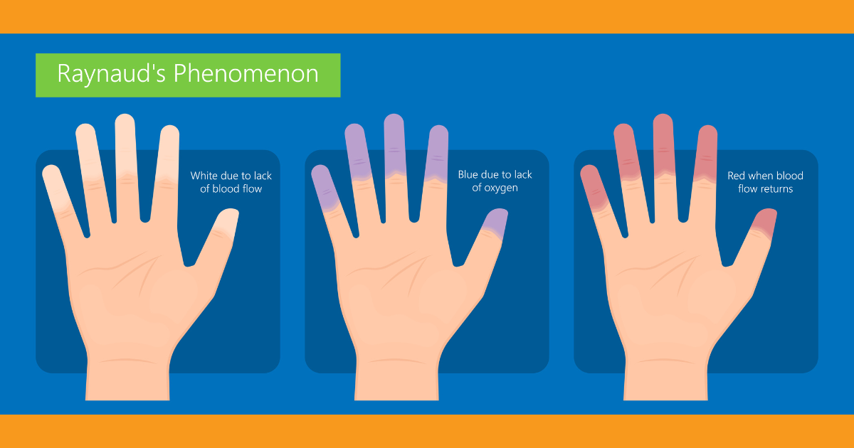 Raynaud’s Phenomenon Signs