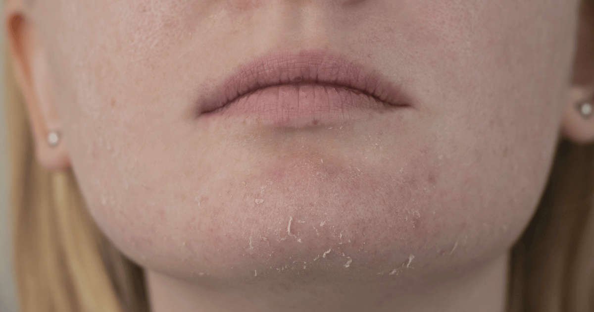 how to cure dry skin on face overnight